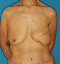 下腹部の脂肪組織（深下腹壁動脈穿通枝皮弁）による乳房再建後。下垂のある、自然な乳房形態の再現ができる。